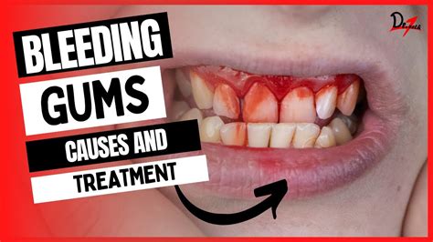 Bleeding Gums Causes & Treatment - YouTube