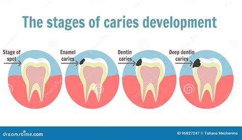 Stages Of Caries Development. Dental Disease: Caries, Pulpitis And Periodontitis, Realistic ...