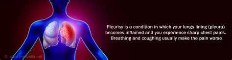 Pleurisy - Frequently Asked Questions