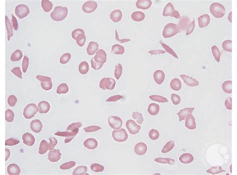 Sickle cells