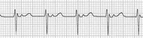 Junctional & Ventricular Rhythms Jeopardy Template