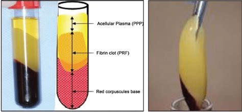 Left: Blood on the vacutainer tubes after centrifugation, divided into... | Download Scientific ...