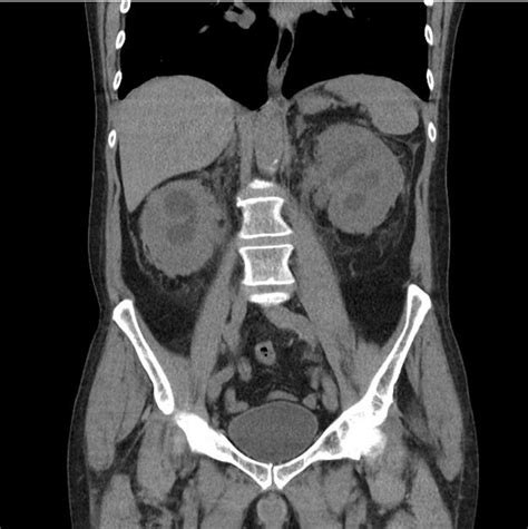 Coronal CT scan showing increasing perinephric soft tissue around... | Download Scientific Diagram