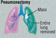 Pneumonectomy Guide | Drugs.com