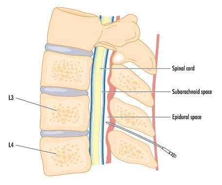 Lumbar Transforaminal Epidural Steroid Injection - Delaware Valley Pain & Spine ...