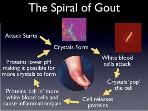 Gout and pseudogout