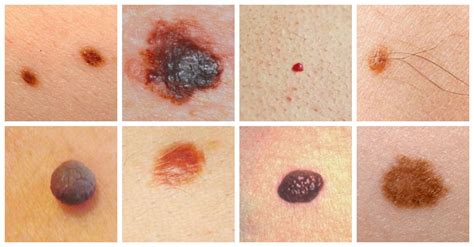 Skin Cancer - Causes, Symptoms and Treatment | Health Care "Qsota" - Tips and Tricks Doctors