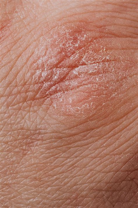 A Guide to Recognizing Morgellons Disease - Syndication Cloud