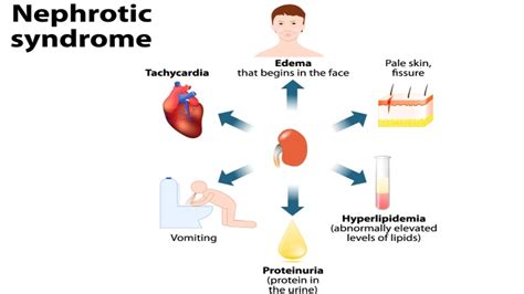 Symptoms of Nephrotic Syndrome - ThopTvNews.com