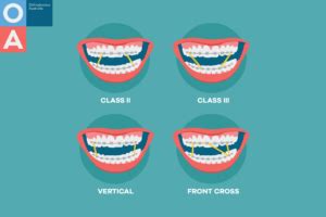 Orthodontics Australia | Elastics For Braces: Rubber Bands in Orthodontics