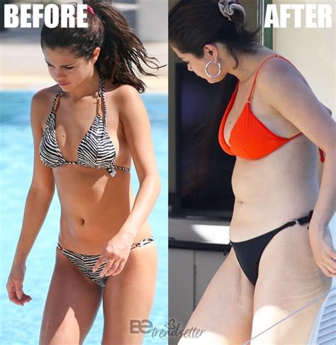 Selena Gomez Plastic Surgery Revealed! Before and After