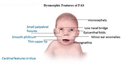 Fetal Alcohol Spectrum Disorders - HealthyChildren.org