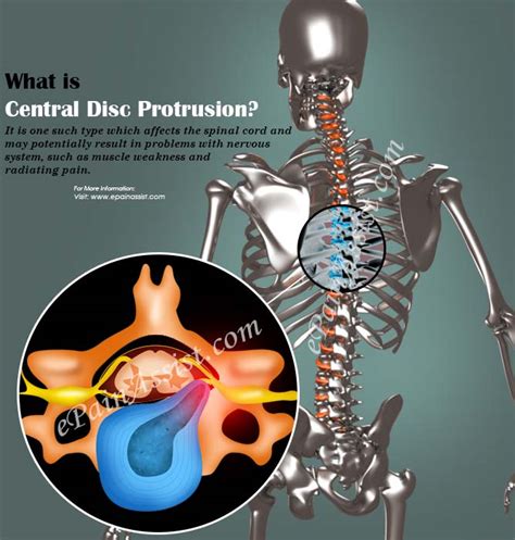 Central Disc Protrusion|Causes|Symptoms|Treatment