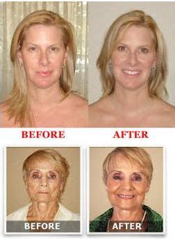 Lifecell Anti wrinkle Cream Before and After Photos. Free 30-Days Trial ...