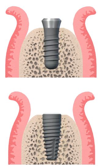 The benefits of tissue level implants restoratively - ITI Blog