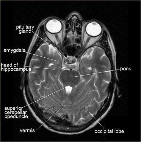 Axial Brain Mri