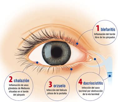 Orzuelo y chalazión: ¿qué son? – Instituto Oftalmologico Aisenberg