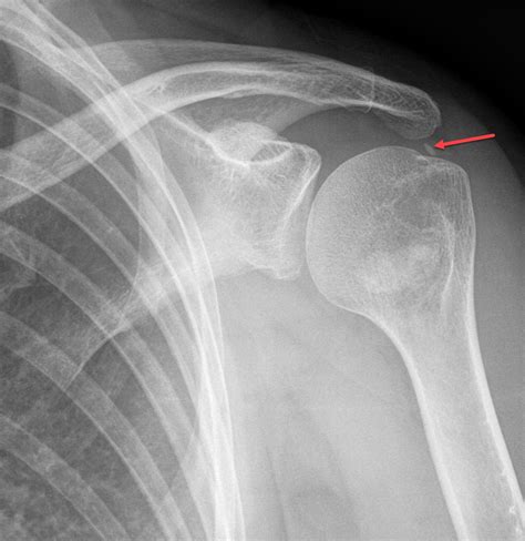 Calcific tendinosis - Radiology For Beginners by Dr. Samuel Kobba