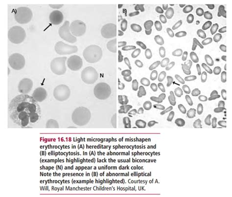 Hereditary Elliptocytosis and Spherocytosis: Diagnosis and treatment