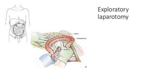 Laparotomy – opening and closing