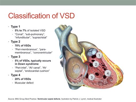 Surgical Repair of Atrioventricular Septal Defect – Dimas Yusuf