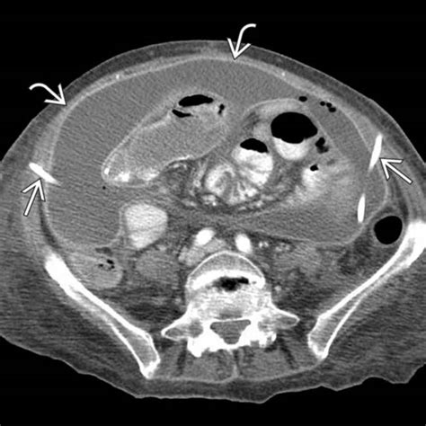 Pelvic Peritonitis