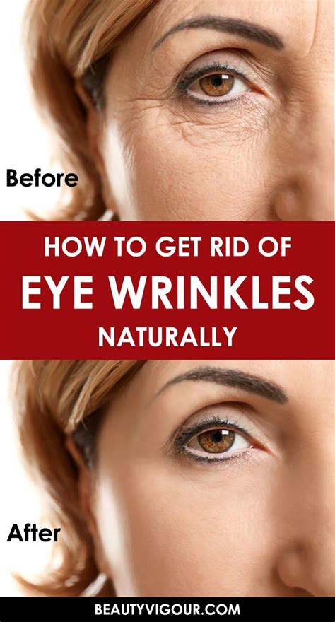 How To Get Rid Of Eye Wrinkles Naturally - BeautyVigour | Wrinkles remedies face, Eye wrinkle ...