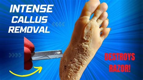 CALLUS REMOVAL!! - YouTube