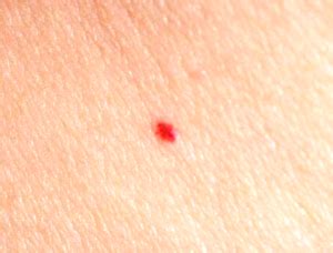 What Causes Little Red Dot on the Skin? | New Health Advisor