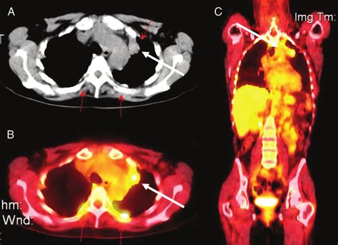 FDG-PET scan identification of a primary lung carcinoma in a patient... | Download Scientific ...