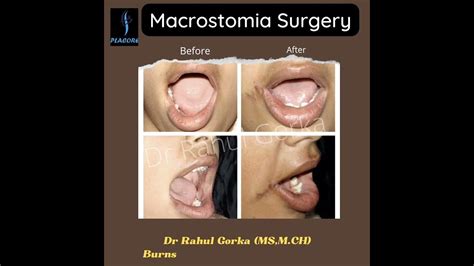 MACROSTOMIA REPAIR #DrRahuGorka #Lip-reconstruction # ...