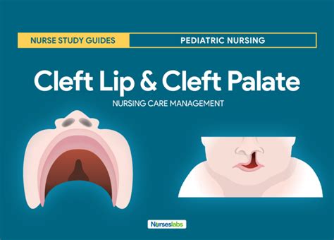 Cleft Lip and Cleft Palate Nursing Care Management