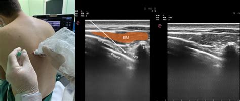 Patient position and sonoanatomy of the paravertebral block. This image... | Download Scientific ...