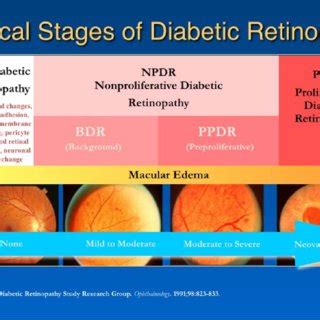 Stages of progression of diabetic retinopathy. Image courtesy of Lloyd... | Download Scientific ...