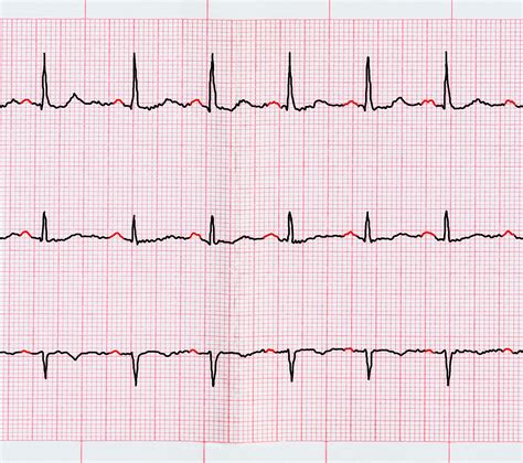 Ventricular Fibrillation