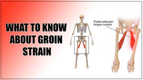 Expert Physical Therapy Guide to Recover Groin Strain – Oklahoma ...