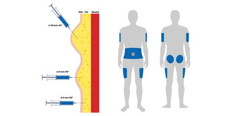 The Basics Of Insulin Injection Sites On The Body – Where And How To ...