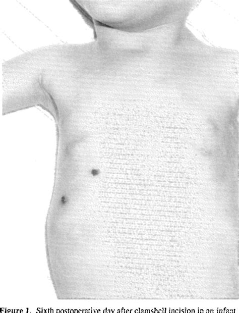 Figure 1 from Clamshell Incision for Simultaneous Correction of Aortic ...