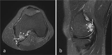 Prayer's fracture: rare cases of knee insufficiency fracture in non ...