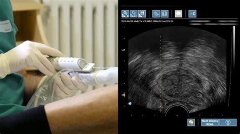 3D MRI/Ultrasound Fusion Prostate Biopsy for Urologists