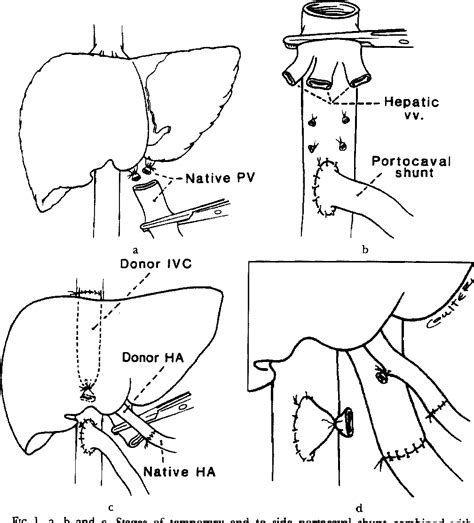 Figure 1 from Temporary end to side portacaval shunt in orthotopic ...