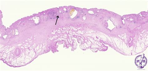 11.Gallbladder, Pancreas (1) Cholelithiasis ・Chronic cholecystitis ...