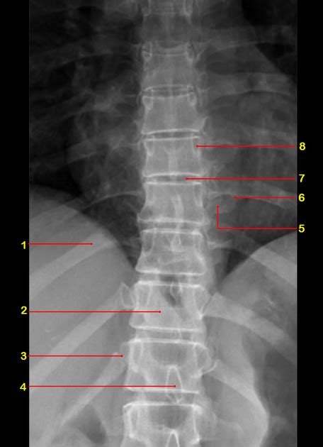 Lumbar Vertebrae Anatomy Xray