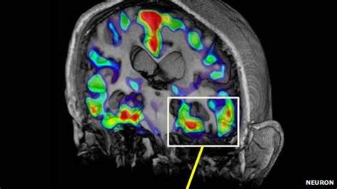 Alzheimer’s brain scan detects tau protein | Headlines