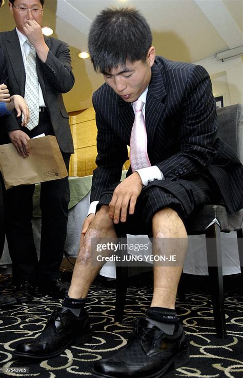 Shin Dong-Hyuk, a North Korean defector, shows scars on his leg... News ...