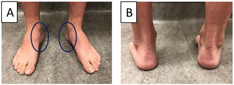 微妙なCavovarus Foot。 A Missed Risk Factor for Chronic Foot and Ankle Pathologies | Tomas Rosprim