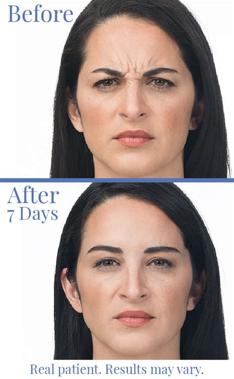 botox-lakewood-frown-lines-before-after - Rocky Mountain Laser College