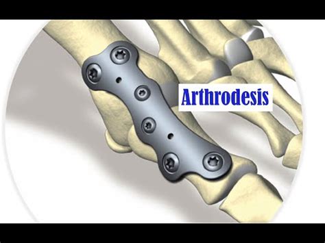 Arthrodesis CPT codes - simplify medical coding - YouTube