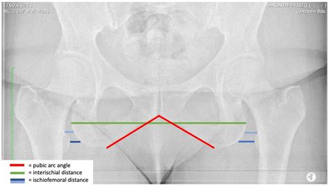 JCM | Free Full-Text | The Female Pelvis Is Associated with a Lateralized Ischium and a Reduced ...