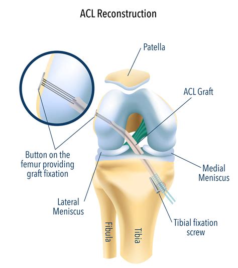 Hamstring Tendon